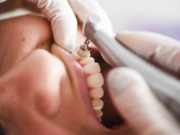 Precio limpieza dental